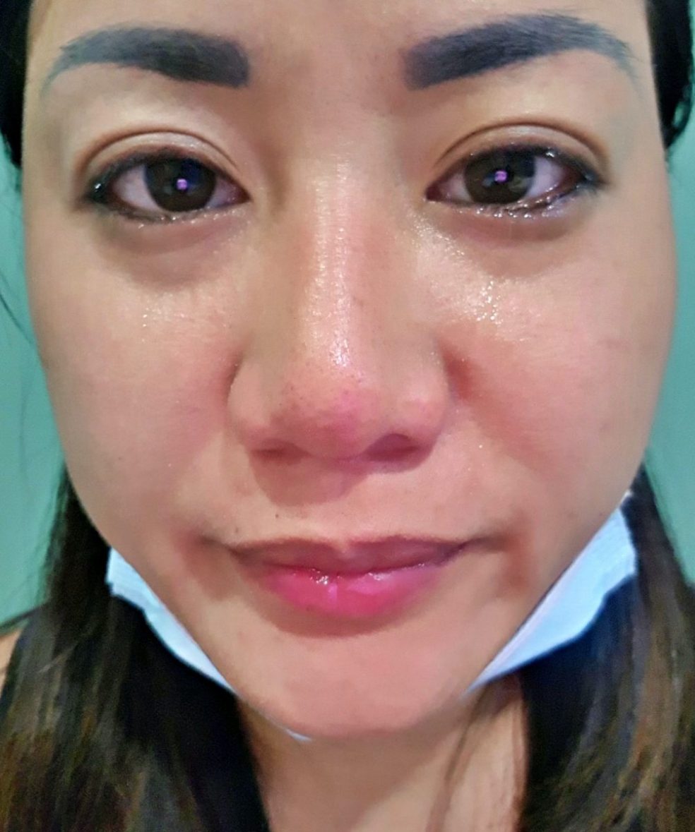 open appendectomy philippines